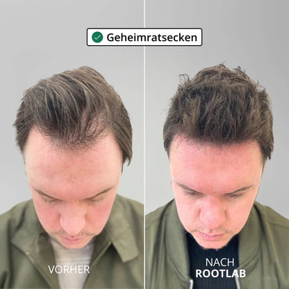 Apex Hair Regrowth System