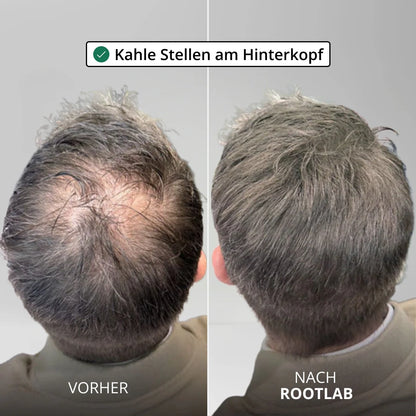 Apex Hair Regrowth System