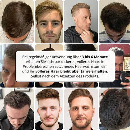 Apex Hair Regrowth System