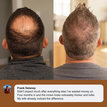 Apex™ Hair Regrowth System